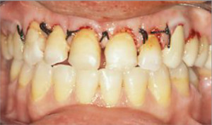 Rehabilitación completa, fundas de porcelana y tratamiento periodontal