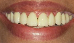 Rehabilitación completa, fundas de porcelana y tratamiento periodontal