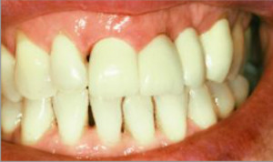 Cirugía periodontal y estética dental